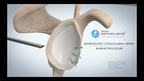 ARTHROSCOPIC SHOULDER STABILISATION (BANKART PROCEDURE) - DR MATTHIEU ...