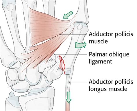 Bennett fracture causes, symptoms, diagnosis, treatment & prognosis