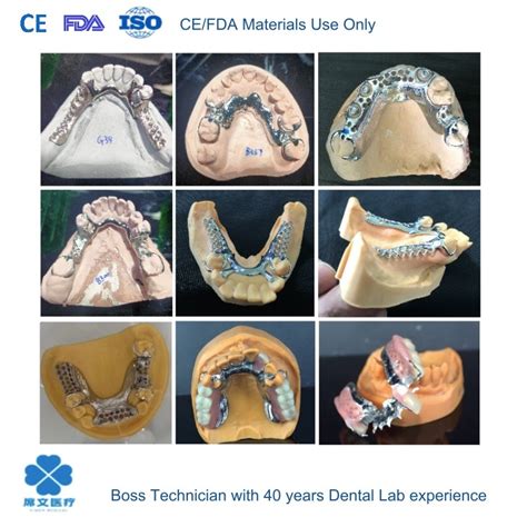 Dental Lab Removable Denture of Metal Framework for Cast Partial ...