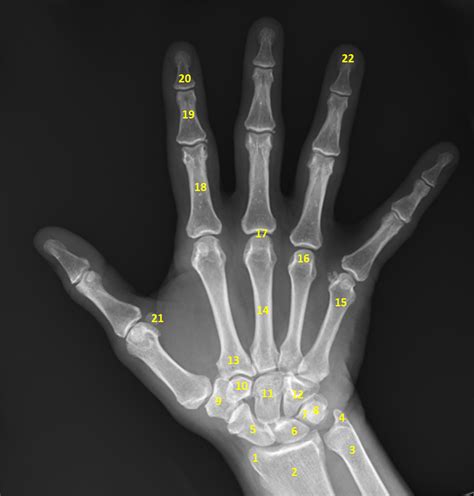 Xray Of Hand Bones