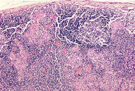 Lepromatous Leprosy Histology