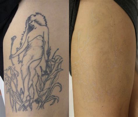 Natural Tattoo Removal: Dermabrasion Tattoo Removal - The Fact