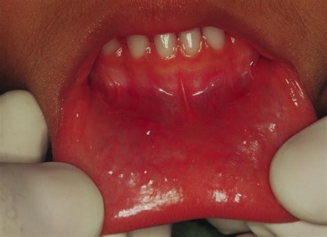 Retention mucocele on the lower lip associated with inadequate use of ...