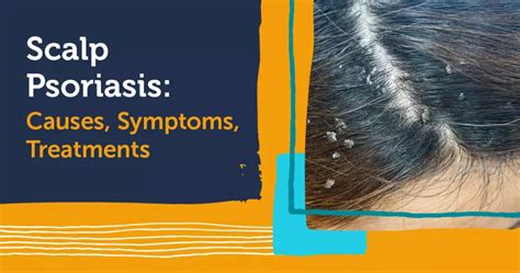 Scalp Psoriasis: Causes, Symptoms, and Treatments | MyPsoriasisTeam