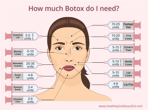 Botox Around Mouth-Say Goodbye to Wrinkles (Does it Work?)