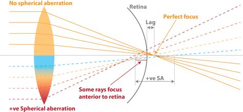 Understanding spherical aberration - Myopia Profile