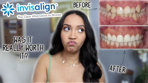 INVISALIGN REVIEW IS IT WORTH IT? - YouTube