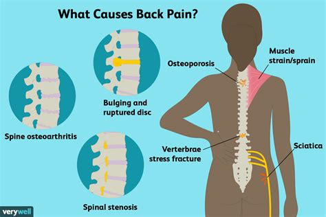 THE POSITIVE EFFECTS OF ACUPUNCTURE FOR BACK PAIN (Backed by WHO) — IN ...