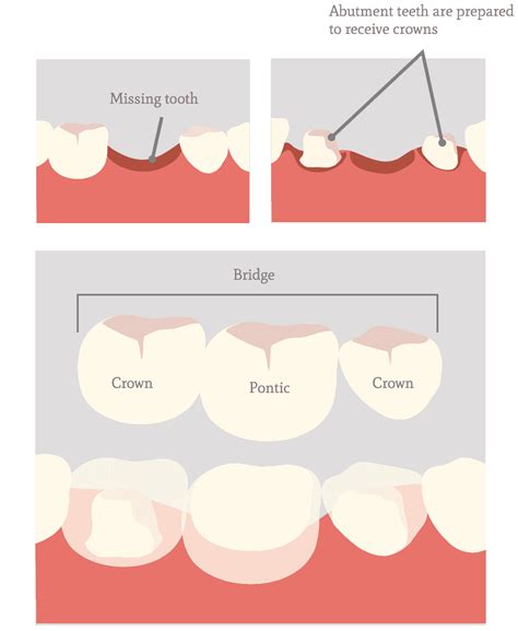 Dental Bridge Abutment