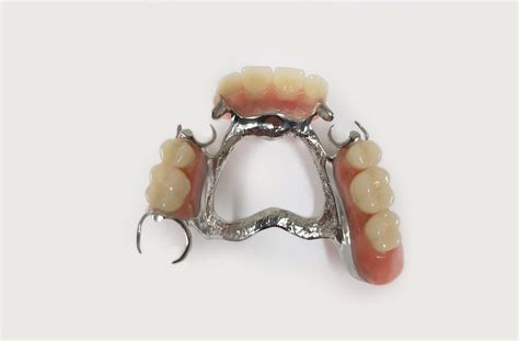 Metal Partial Dentures Wantirna, Boronia, Bayswater, Heathmont & Scoresby