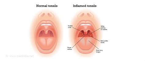 Little White Spots On Tonsils