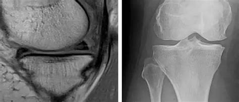 Standing X-Ray Versus MRI