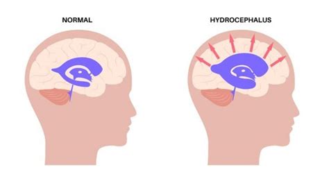 Precautions To Take If You Have Hydrocephalus