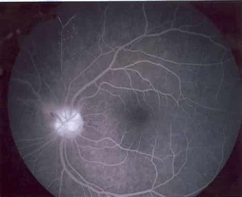 Fluorescein Angiography: What You Should Know | EYExan.com