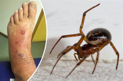 False widow spider bite left dad in hospital with viral meningitis ...