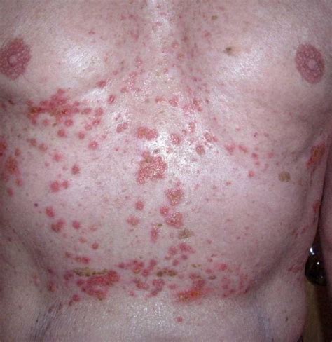 Grover's disease: Symptoms, causes, pictures, treatment