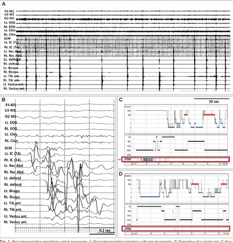 Figure 1 from Treatment of Propriospinal Myoclonus at Sleep Onset ...