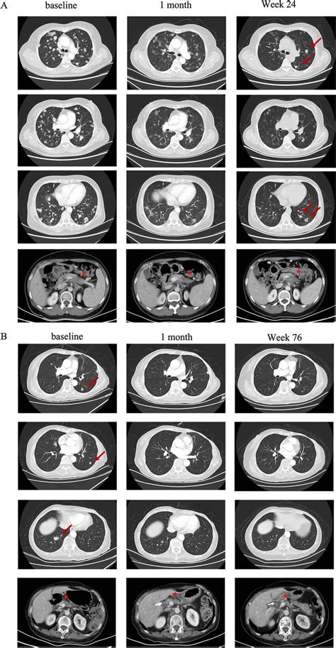 Radiological evaluation of lung lesions in case 1 (A) and case 2 (B ...