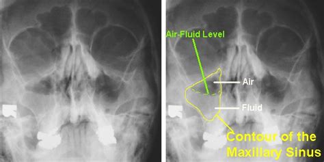 Imaging of Maxillary Sinusitis (Waters View, CT Scan, MRI ...