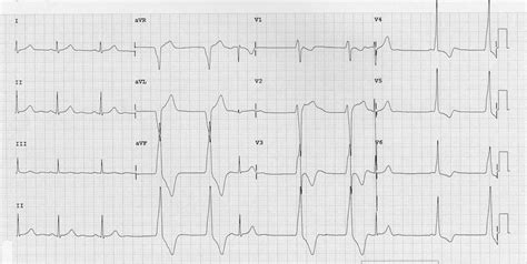 Accelerated Idioventricular Rhythm (AIVR) • LITFL • ECG Library