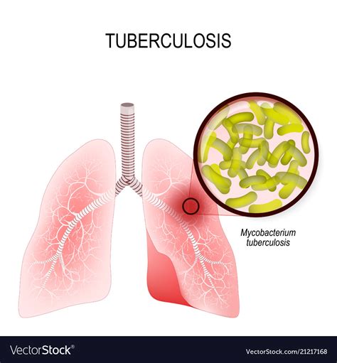 Tuberculosis is an infection caused bacteria Vector Image