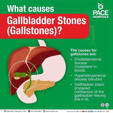 Understanding Bladder Stones: Causes, Symptoms, and Prevention