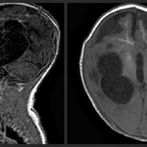 Sagittal/ Axial MRI head-Markedly dilated temporal horns of lateral ...