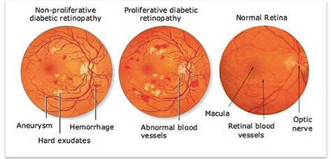 Diabetic Eye Conditions Explained | Hesed Eye Specialists