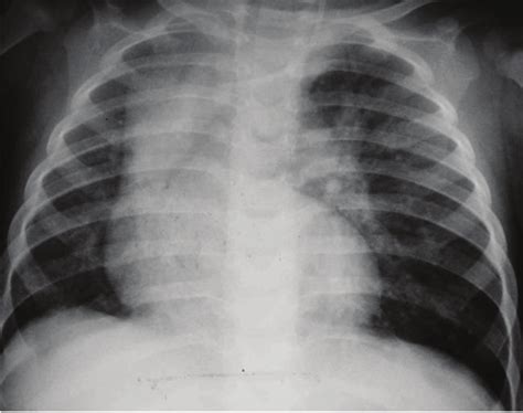 Chest X-ray showing hyperinflation of the left upper lobe, with ...