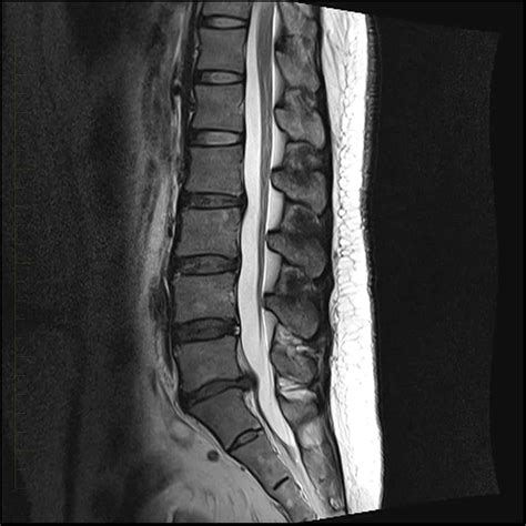 MRI of the Lower Back - Diagnostic Imaging - Melbourne Radiology