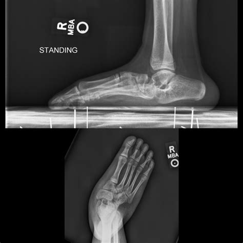 [Figure, Congenital vertical talus. Vertical orientation ...