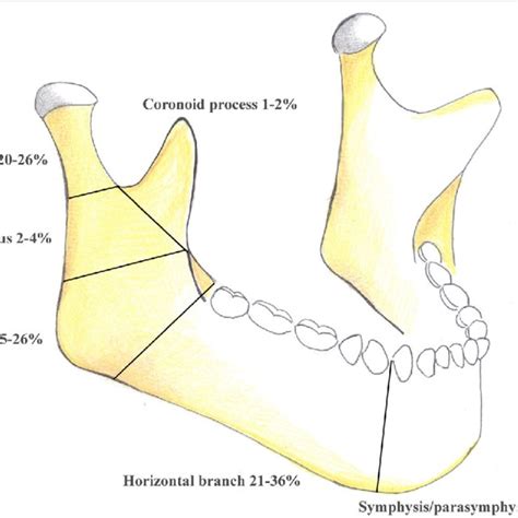 Dentition classification of mandibular fracture. • Class I: Teeth are ...