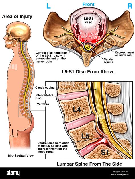 S1 nerve root hi-res stock photography and images - Alamy