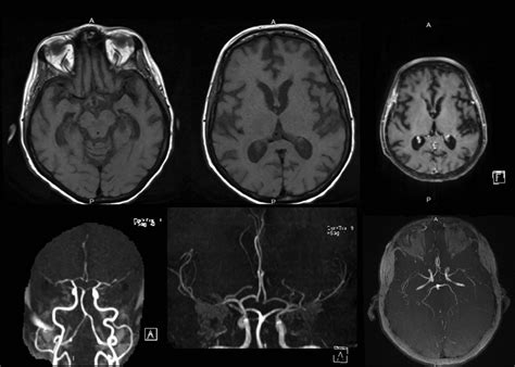 Hashimoto's Encephalopathy Masquerading as Rapidly Progressive Dementia ...