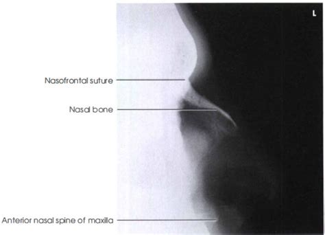 Nasal Bone : Lateral View - RadTechOnDuty