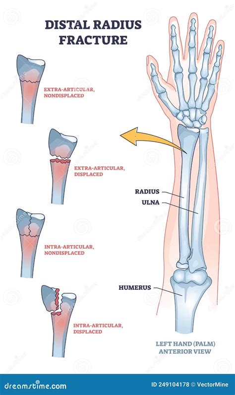 Fractura De Radio Distal Y Tipo De Hueso Del Brazo Roto Diagrama De ...