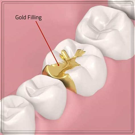 Gold Fillings: Pros and Cons - Engiomed