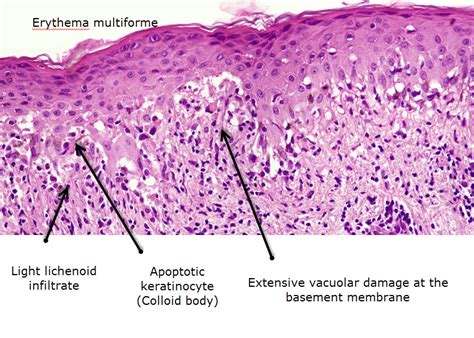 Dermatopathology Made Simple - Inflammatory: Lichenoid / Vacuolar ...