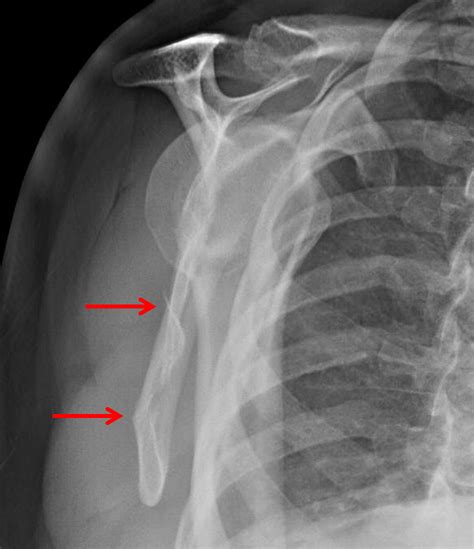 Lateral Scapula X Ray