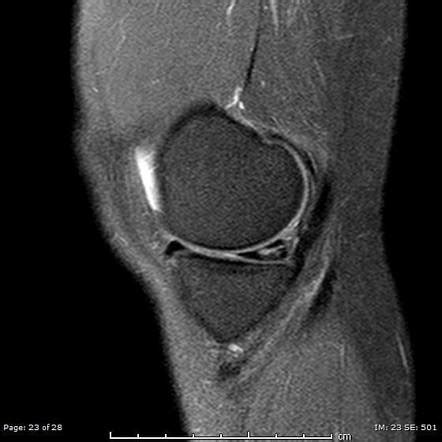 Medial Meniscus Tear Mri