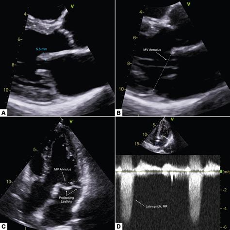 Bileaflet mitral valve prolapse resulting in mild-moderate mitral ...