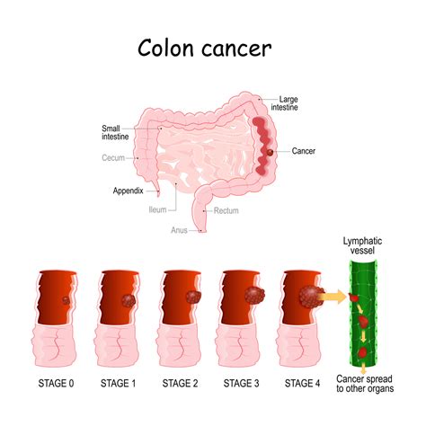 I Have Colon Cancer. What Now? | GI Associates