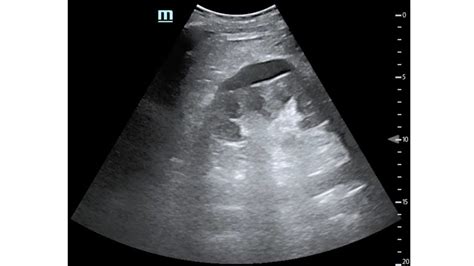 Hiding in Plain Sight: A Case of Perinephric Abscess Diagnosed by POCUS ...