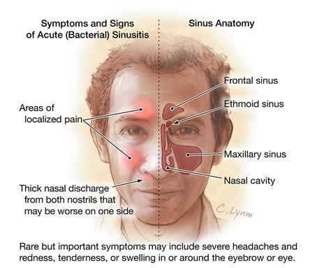 Adult Sinusitis | Otolaryngology | JAMA | JAMA Network