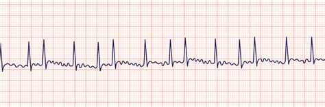 ACLS Rhythm Strips Training and Interpretation