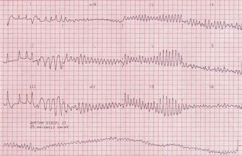 Fine Ventricular Fibrillation