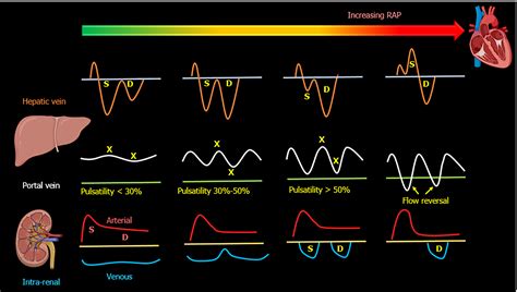 Point of care venous Doppler ultrasound: Exploring the missing piece of ...