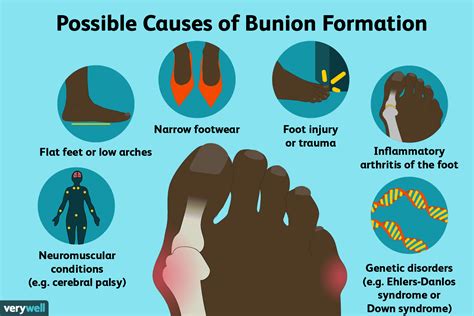 Bunions: Symptoms, Causes, Diagnosis, and Treatment