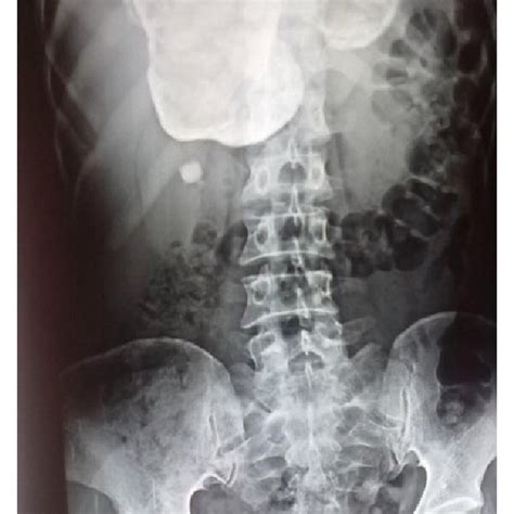 X-ray showing calcified hydatid cyst of liver. | Download Scientific ...