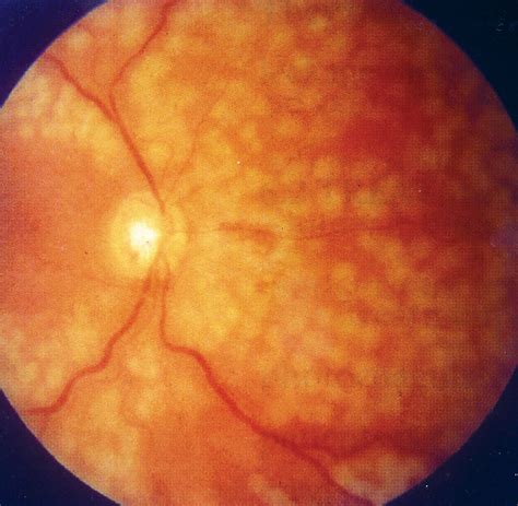 Laser pan-retinal photocoagulation – OSCEstop